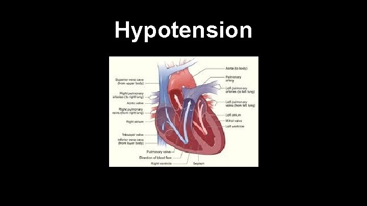 Hypotension 