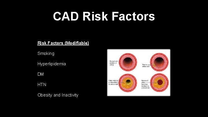 CAD Risk Factors (Modifiable) Smoking Hyperlipidemia DM HTN Obesity and Inactivity 
