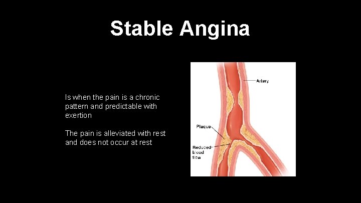 Stable Angina Is when the pain is a chronic pattern and predictable with exertion