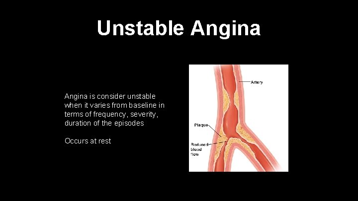 Unstable Angina is consider unstable when it varies from baseline in terms of frequency,