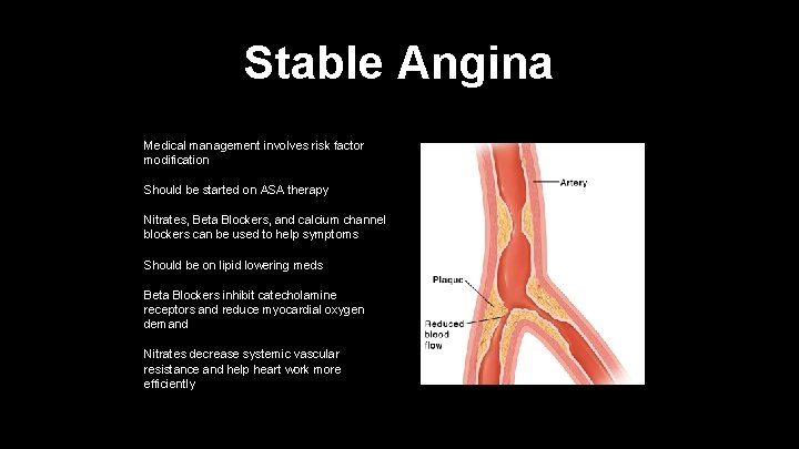 Stable Angina Medical management involves risk factor modification Should be started on ASA therapy