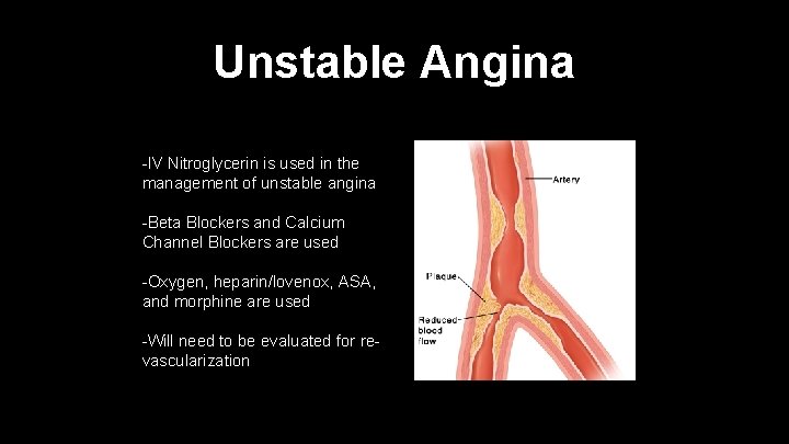 Unstable Angina -IV Nitroglycerin is used in the management of unstable angina -Beta Blockers