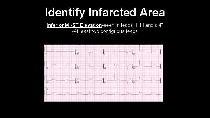 Identify Infarcted Area Inferior MI-ST Elevation-seen in leads II, III and av. F -At