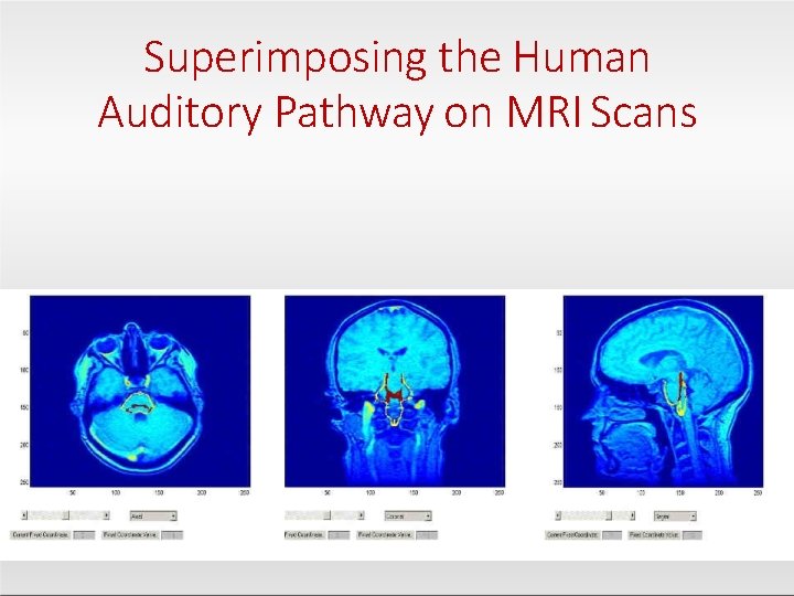 Superimposing the Human Auditory Pathway on MRI Scans 