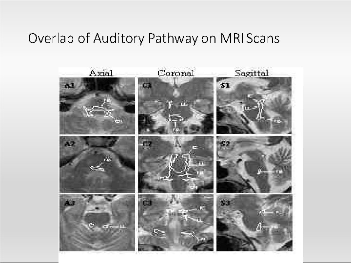 Overlap of Auditory Pathway on MRI Scans 