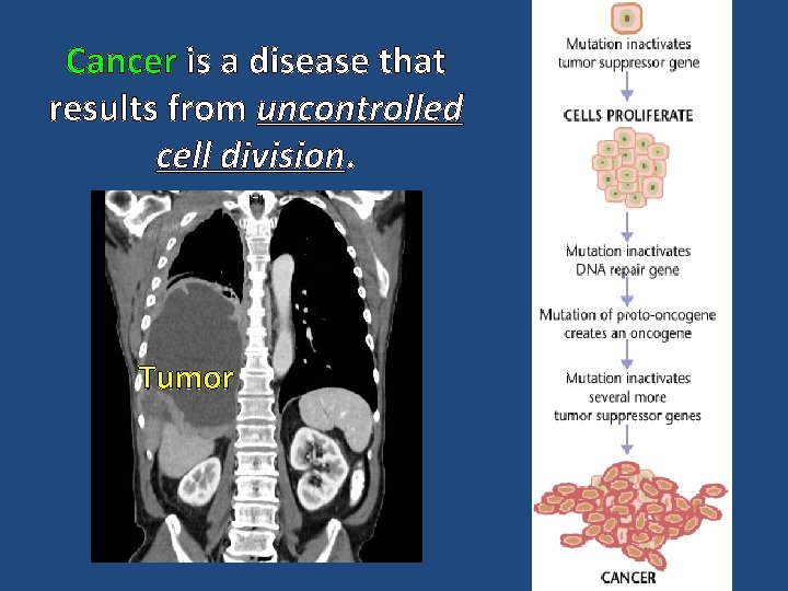 Cancer is a disease that results from uncontrolled cell division. Tumor 