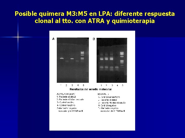 Posible quimera M 3: M 5 en LPA: diferente respuesta clonal al tto. con