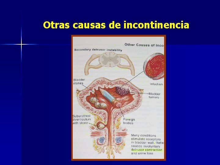 Otras causas de incontinencia 