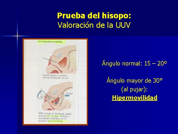 Prueba del hisopo: Valoración de la UUV Ángulo normal: 15 – 20º Ángulo mayor