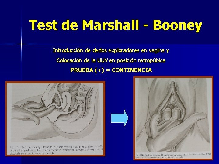 Test de Marshall - Booney Introducción de dedos exploradores en vagina y Colocación de