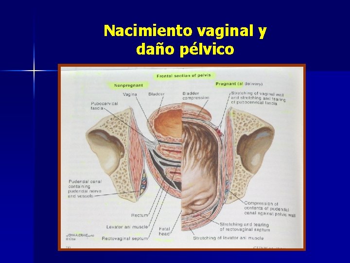 Nacimiento vaginal y daño pélvico 