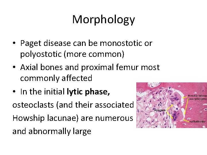 Morphology • Paget disease can be monostotic or polyostotic (more common) • Axial bones