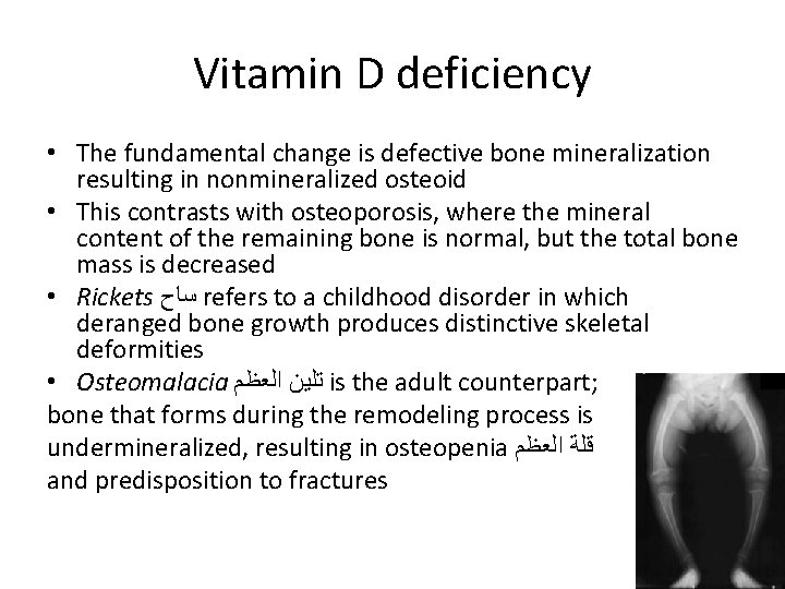 Vitamin D deficiency • The fundamental change is defective bone mineralization resulting in nonmineralized