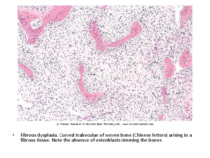  • Fibrous dysplasia. Curved trabeculae of woven bone (Chinese letters) arising in a