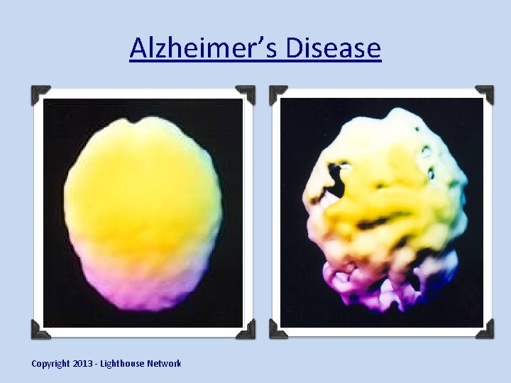 Alzheimer’s Disease Copyright 2013 - Lighthouse Network 