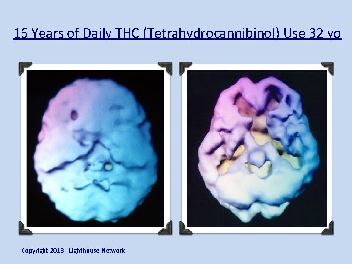 16 Years of Daily THC (Tetrahydrocannibinol) Use 32 yo Copyright 2013 - Lighthouse Network