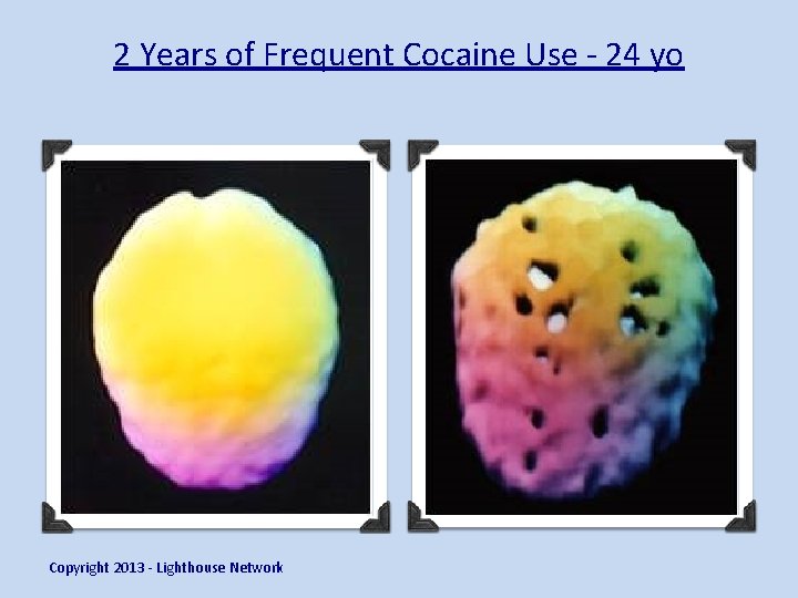 2 Years of Frequent Cocaine Use - 24 yo Copyright 2013 - Lighthouse Network