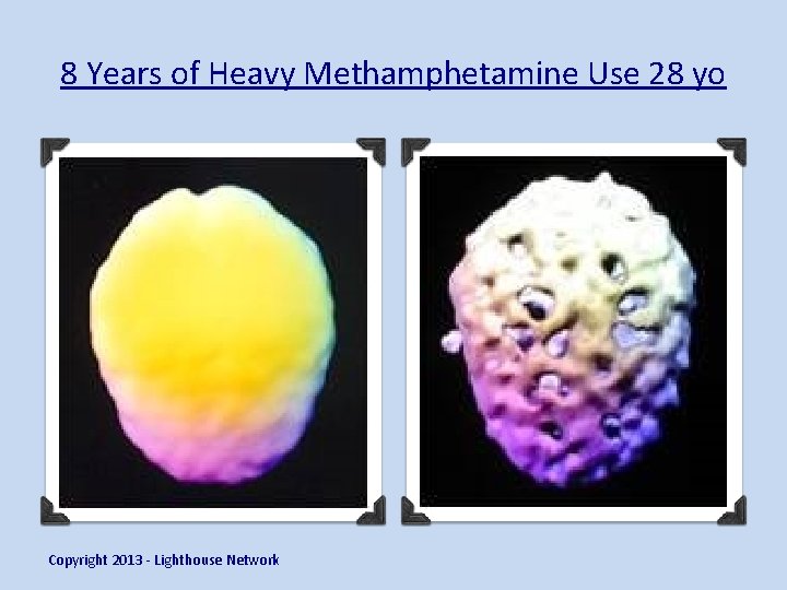 8 Years of Heavy Methamphetamine Use 28 yo Copyright 2013 - Lighthouse Network 
