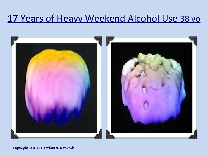 17 Years of Heavy Weekend Alcohol Use 38 yo Copyright 2013 - Lighthouse Network