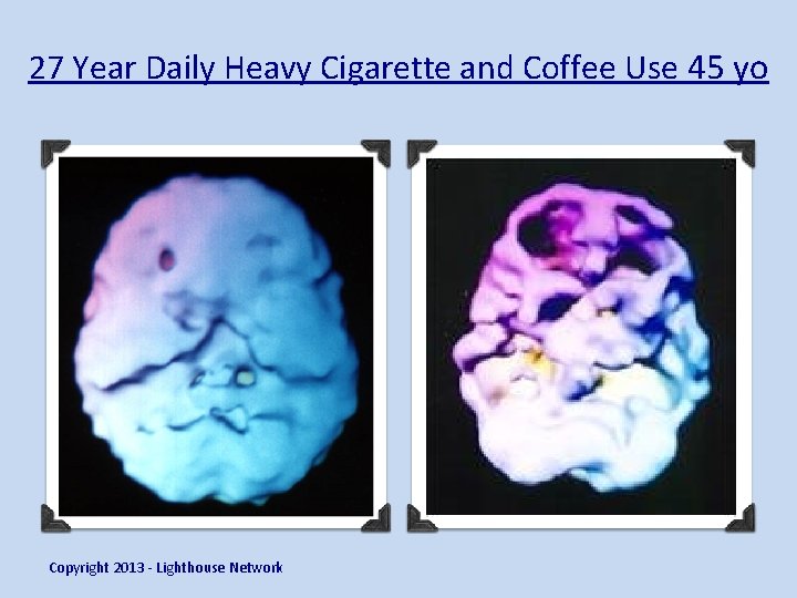 27 Year Daily Heavy Cigarette and Coffee Use 45 yo Copyright 2013 - Lighthouse