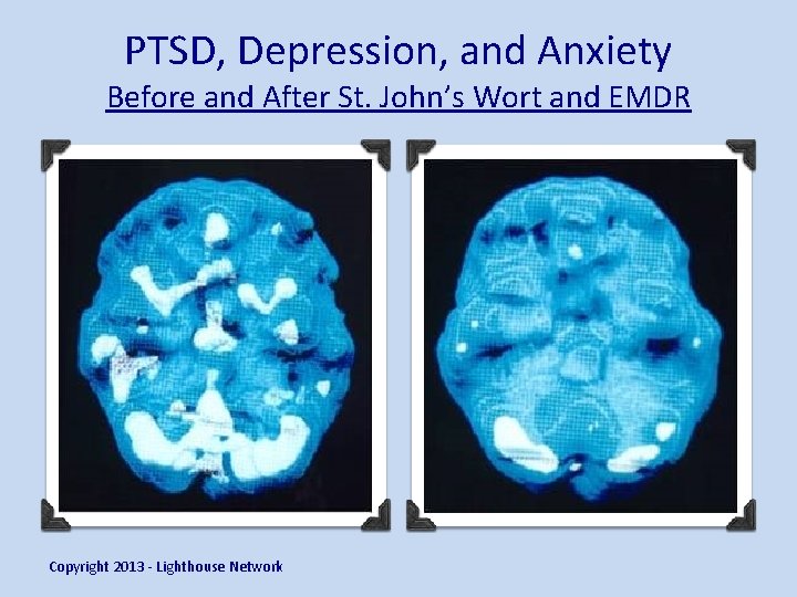 PTSD, Depression, and Anxiety Before and After St. John’s Wort and EMDR Copyright 2013