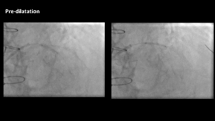 Pre-dilatation 