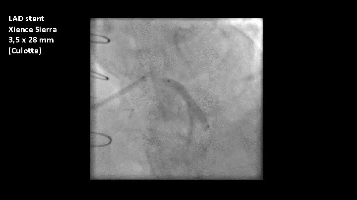 LAD stent Xience Sierra 3, 5 x 28 mm (Culotte) 