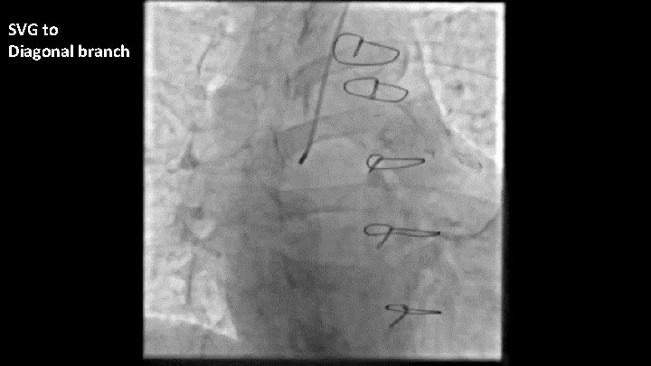 SVG to Diagonal branch 