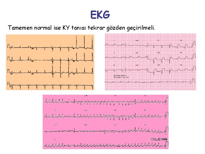EKG Tamemen normal ise KY tanısı tekrar gözden geçirilmeli. 