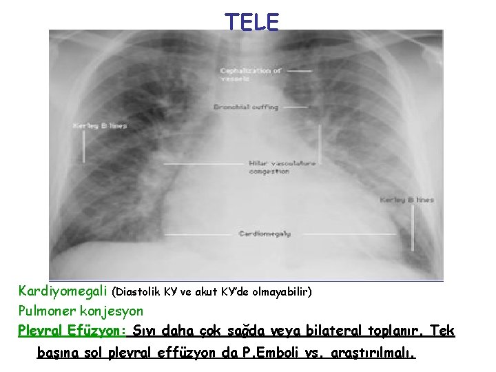 TELE Kardiyomegali (Diastolik KY ve akut KY’de olmayabilir) Pulmoner konjesyon Plevral Efüzyon: Sıvı daha