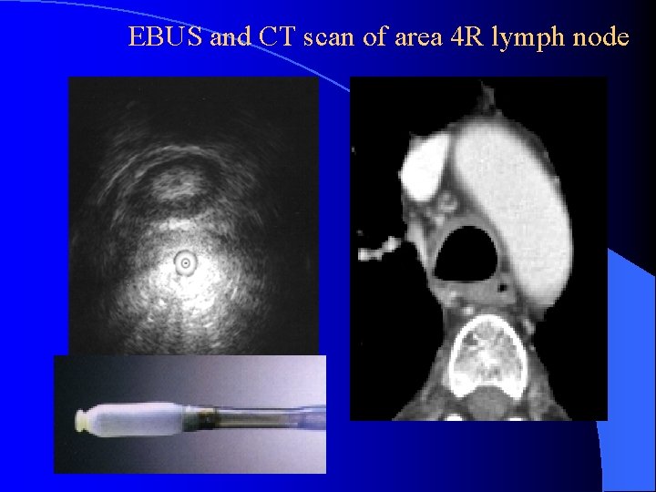EBUS and CT scan of area 4 R lymph node 