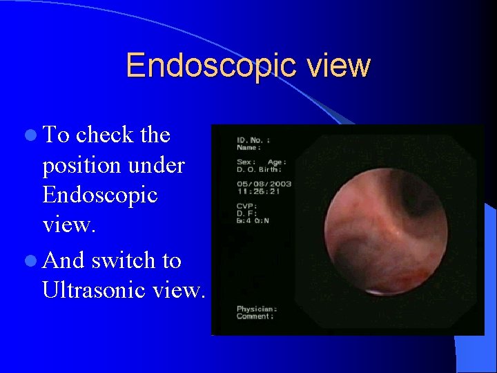 Endoscopic view l To check the position under Endoscopic view. l And switch to