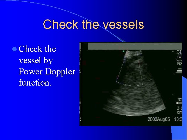 Check the vessels l Check the vessel by Power Doppler function. 