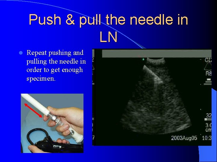 Push & pull the needle in LN l Repeat pushing and pulling the needle