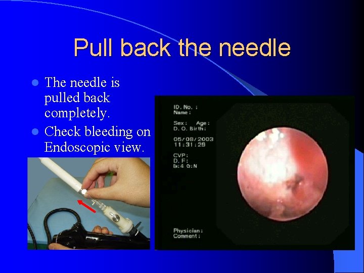 Pull back the needle The needle is pulled back completely. l Check bleeding on
