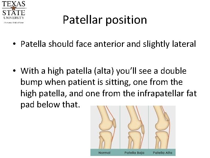 Patellar position • Patella should face anterior and slightly lateral • With a high Patellar position • Patella should face anterior and slightly lateral • With a high