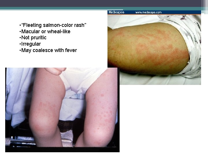  • “Fleeting salmon-color rash” • Macular or wheal-like • Not pruritic • Irregular