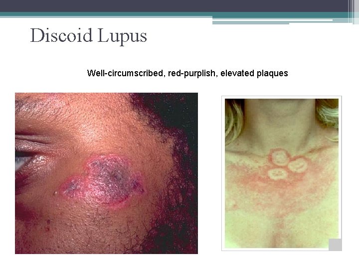 Discoid Lupus Well-circumscribed, red-purplish, elevated plaques 