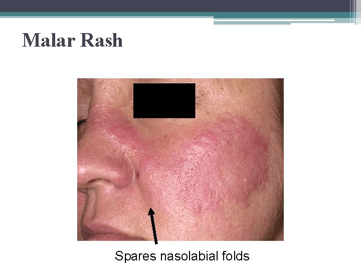 Malar Rash Spares nasolabial folds 