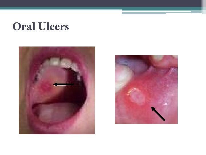 Oral Ulcers 