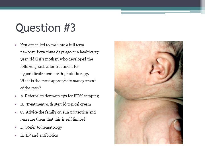 Question #3 • You are called to evaluate a full term newborn three days