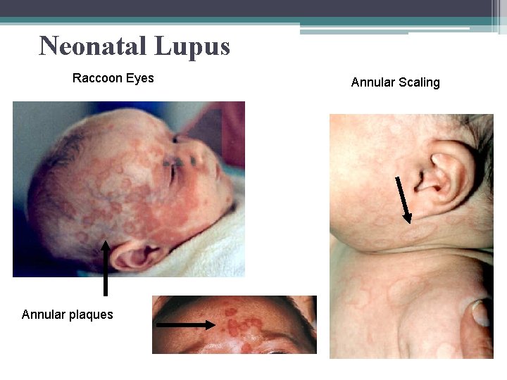 Neonatal Lupus Raccoon Eyes Annular plaques Annular Scaling 