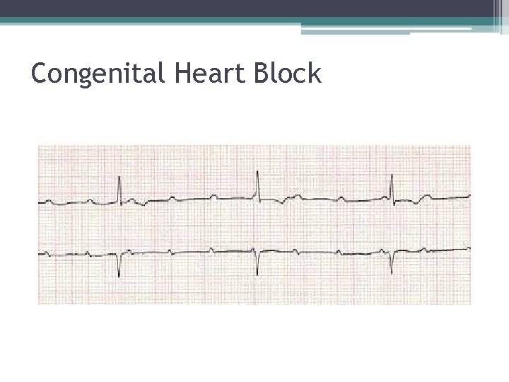 Congenital Heart Block 