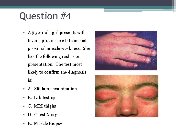 Question #4 • A 9 year old girl presents with fevers, progressive fatigue and