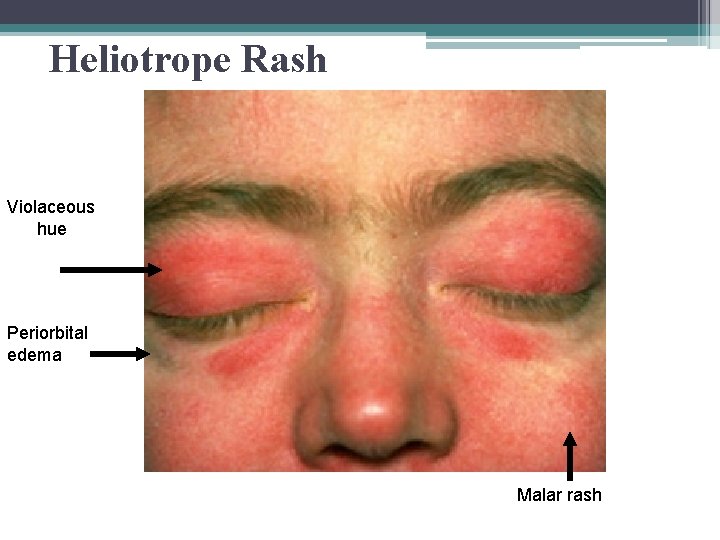 Heliotrope Rash Violaceous hue Periorbital edema Malar rash 