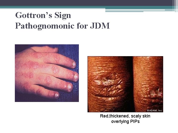 Gottron’s Sign Pathognomonic for JDM Red, thickened, scaly skin overlying PIPs 