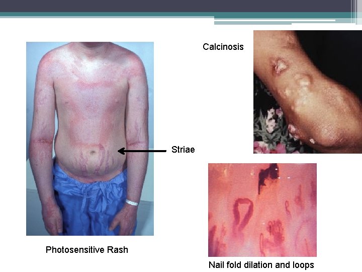 Calcinosis Striae Photosensitive Rash Nail fold dilation and loops 