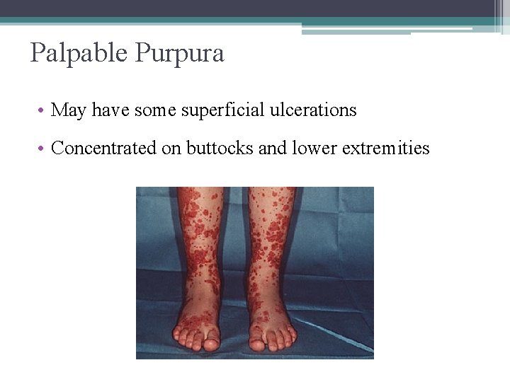 Palpable Purpura • May have some superficial ulcerations • Concentrated on buttocks and lower