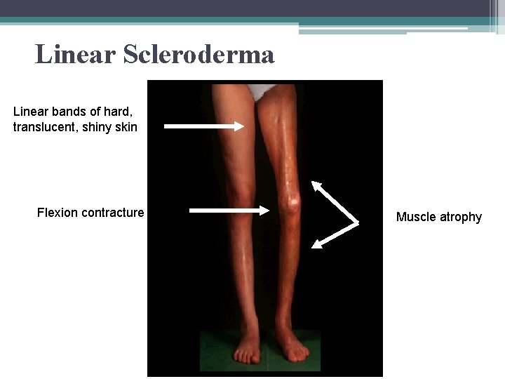 Linear Scleroderma Linear bands of hard, translucent, shiny skin Flexion contracture Muscle atrophy 