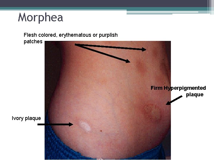 Morphea Flesh colored, erythematous or purplish patches Firm Hyperpigmented plaque Ivory plaque 